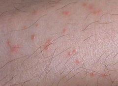 臭虫咬人后图片,一张图带你了解其特征与防治方法