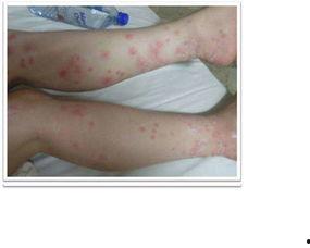 臭虫咬人后图片,一张图带你了解其特征与防治方法