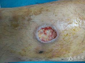 烂皮肤图片,图片背后的肌肤问题解析